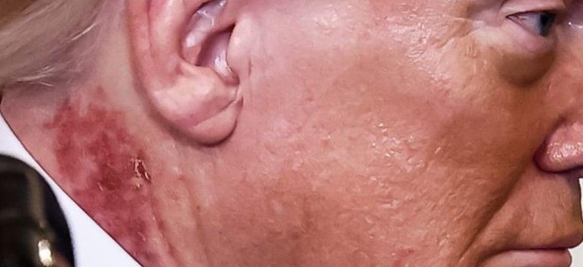 Qué dijo el médico de Donald Trump por la extraña mancha roja del presidente en su cuello