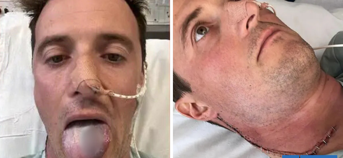 Hombre advierte sobre el Virus del Papiloma Humano: casi perdió su lengua tras desarrollar cáncer