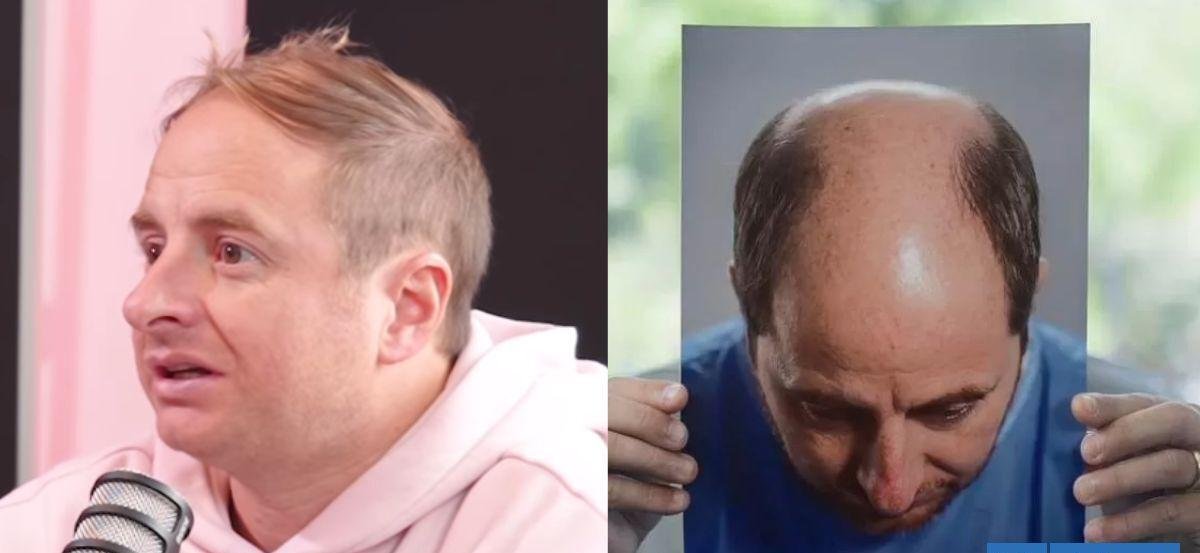 La remontada de Coke Hevia: periodista revela avance de su implante de pelo a un año del inicio