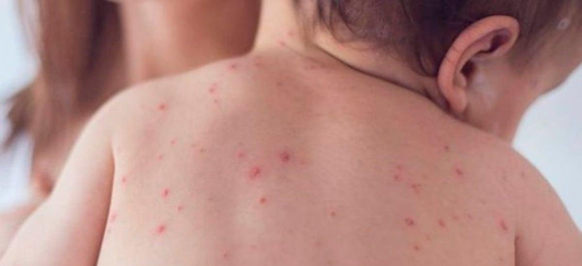 Minsal confirma segundo caso de sarampión importado en lactante que estuvo en México