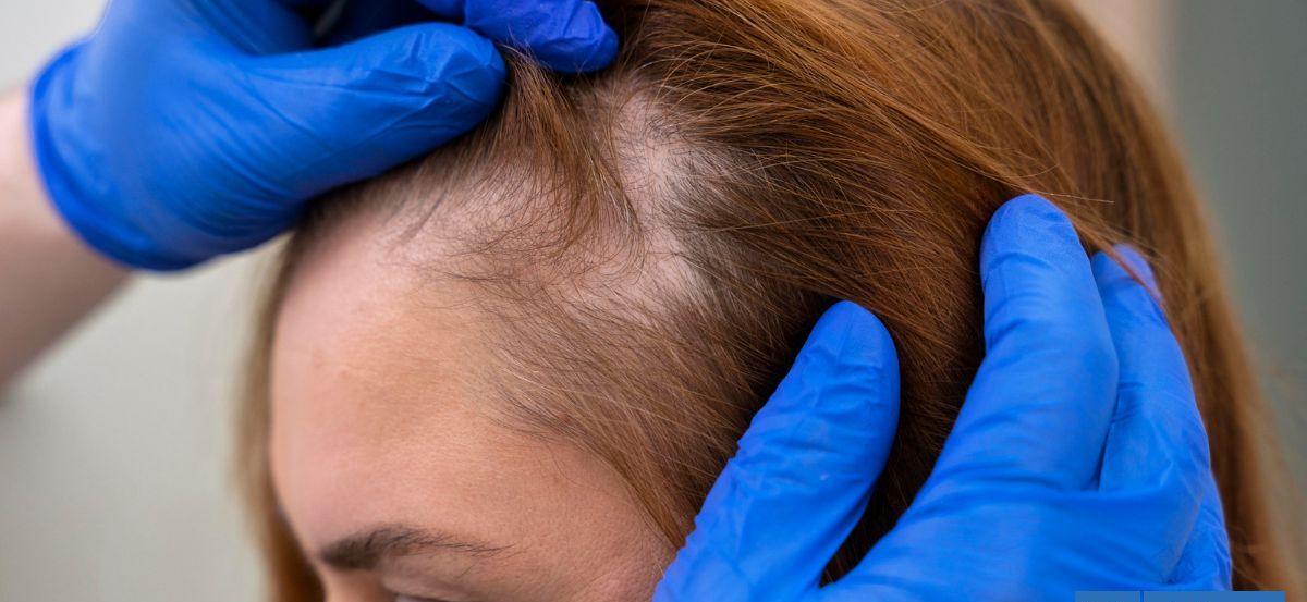 Aumentan consultas por efluvio telógeno, causa de caída del cabello en mujeres: cuáles son las causas