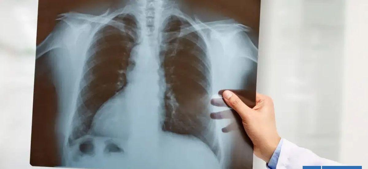 Médicos logran mantener con vida a un hombre sin pulmones por 48 horas: ¿cómo lo hicieron?
