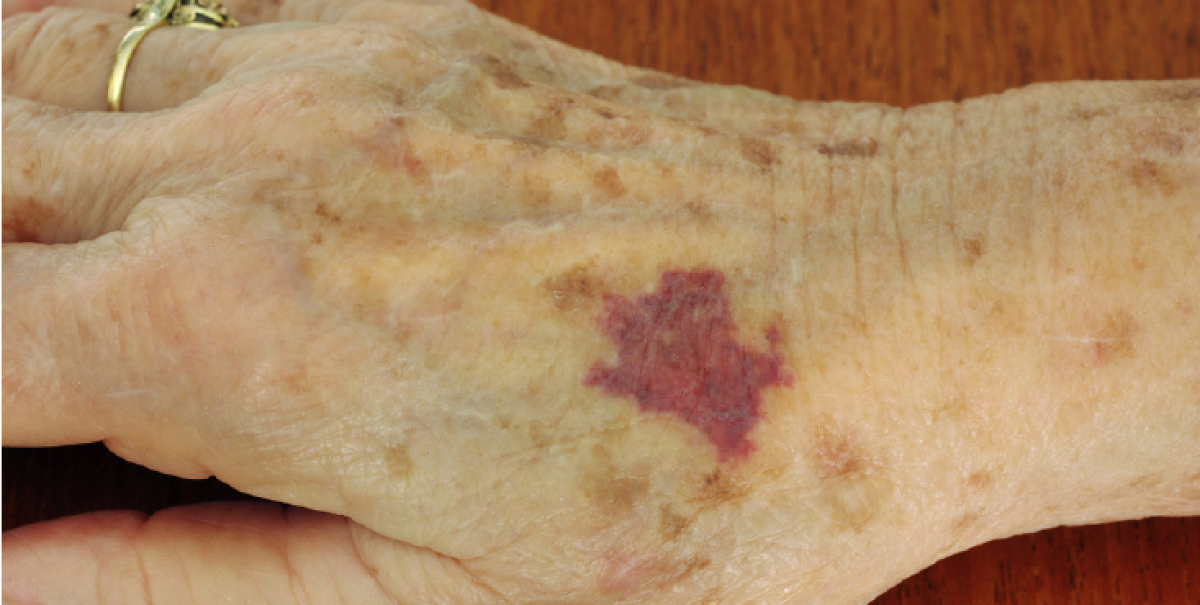 ¿Por qué salen moretones sin golpes en las personas mayores? Causas, señales de alerta y cuidados ante hematomas