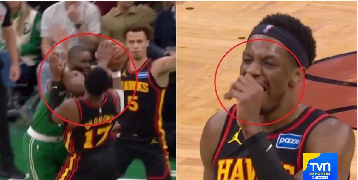 IMÁGENES EXPLÍCITAS | Así quedó el rostro de Onyeka Okongwu tras sufrir "fractura dental" por brutal codazo