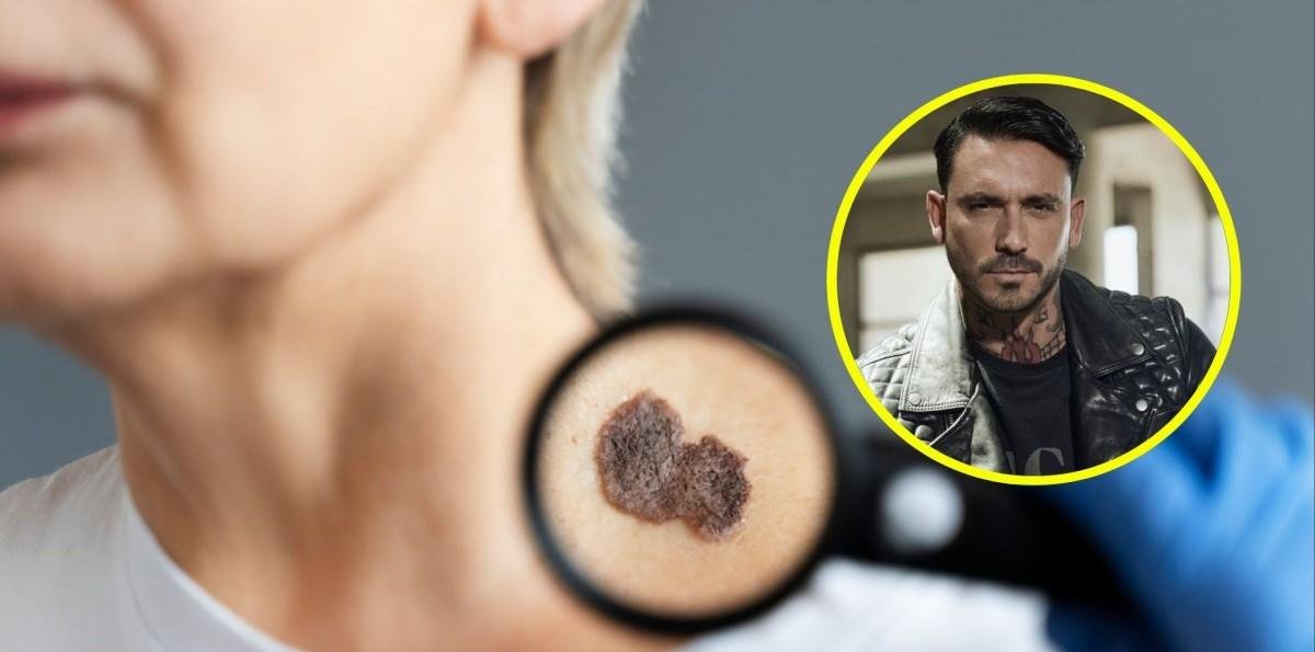 Mauricio Pinilla reveló que tiene cáncer a la piel: ¿Cuáles son los síntomas y cómo prevenir la enfermedad?