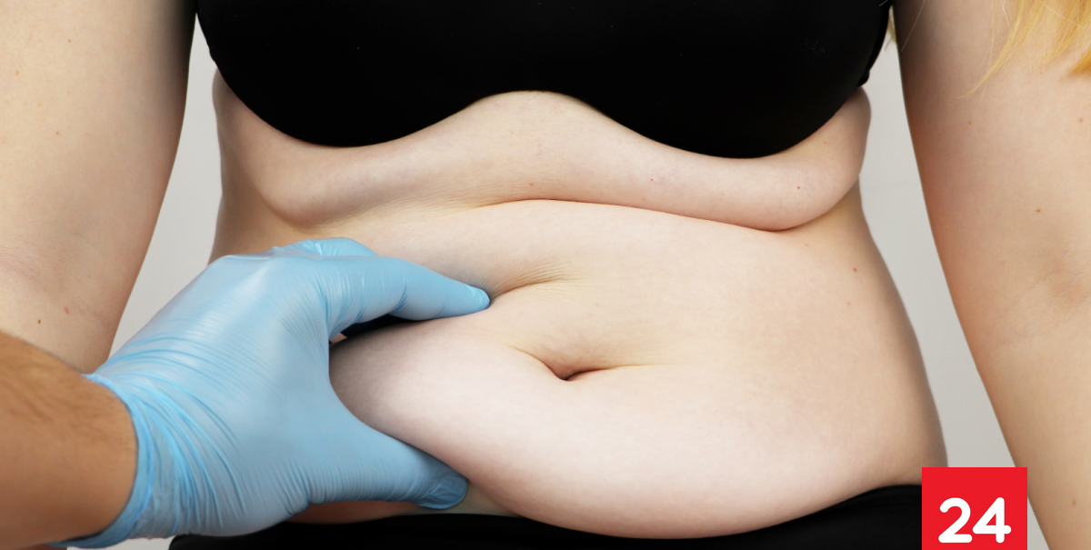 Bono PAD Fonasa para abdominoplastia: requisitos y copago