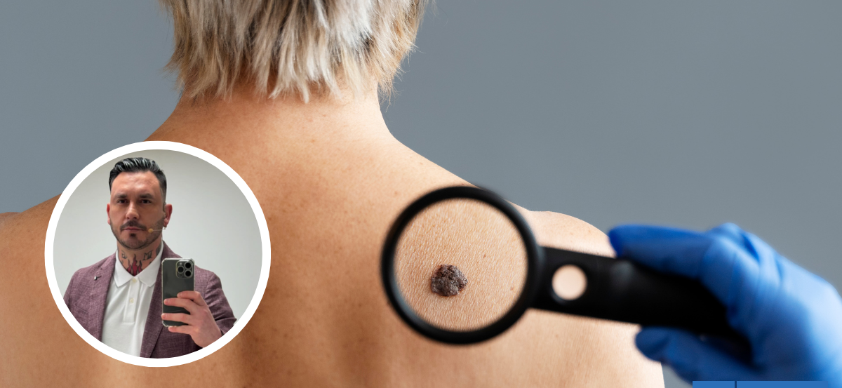 Tras diagnóstico de Mauricio Pinilla: ¿Cuáles son los signos de alerta del cáncer de piel ?