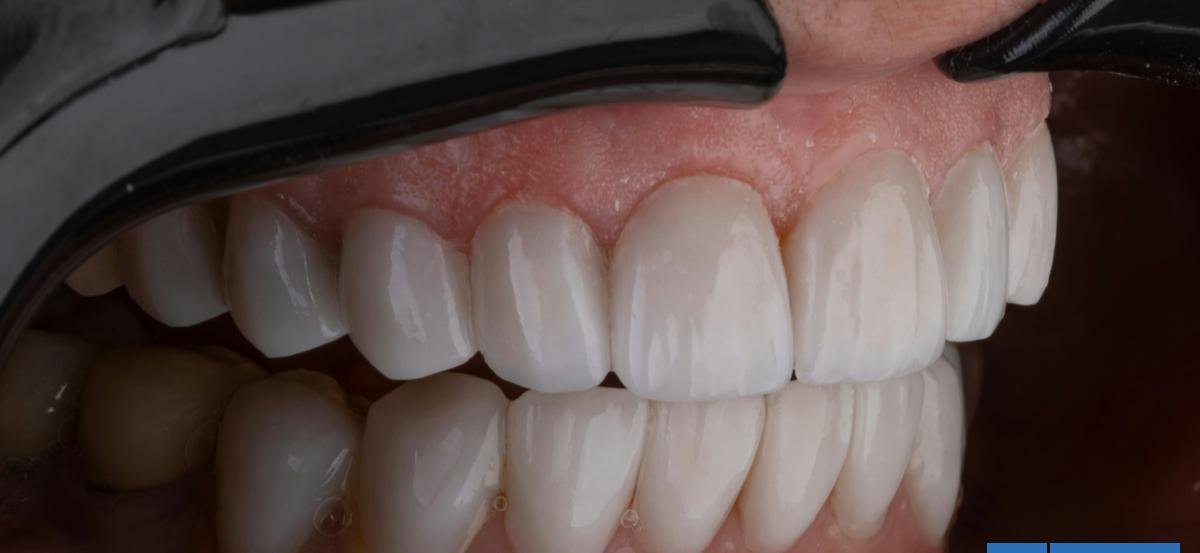 Pérdida dental y cáncer de boca: estudios advierten los graves daños de la marihuana en la salud bucal