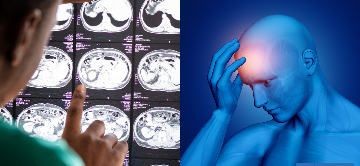 Accidente cerebrovascular: cómo identificar síntomas y factores que elevan el riesgo de sufrir un ACV