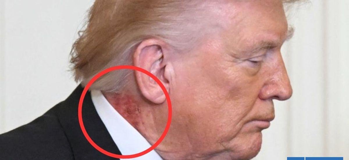 Qué pudo causar el sarpullido de Donald Trump: médico del presidente confirmó tratamiento