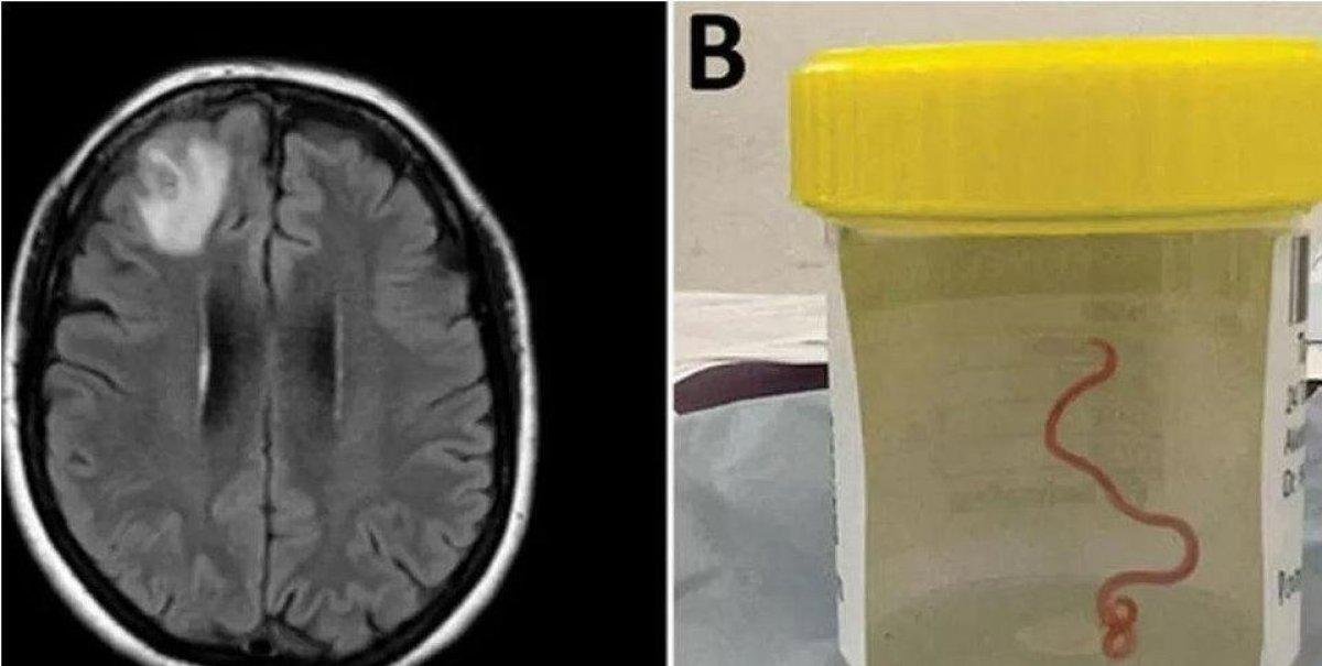 Gusano vivo en el cerebro de una mujer: las noticias de salud que impactaron en 2023