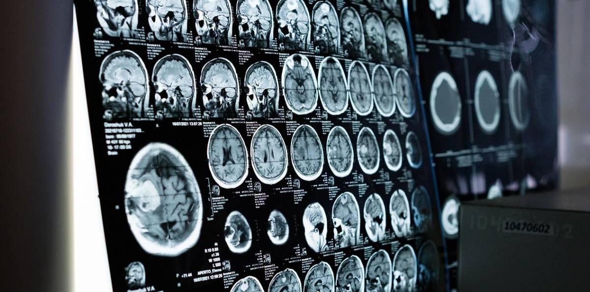 Un fármaco contra las convulsiones podría prevenir el alzhéimer