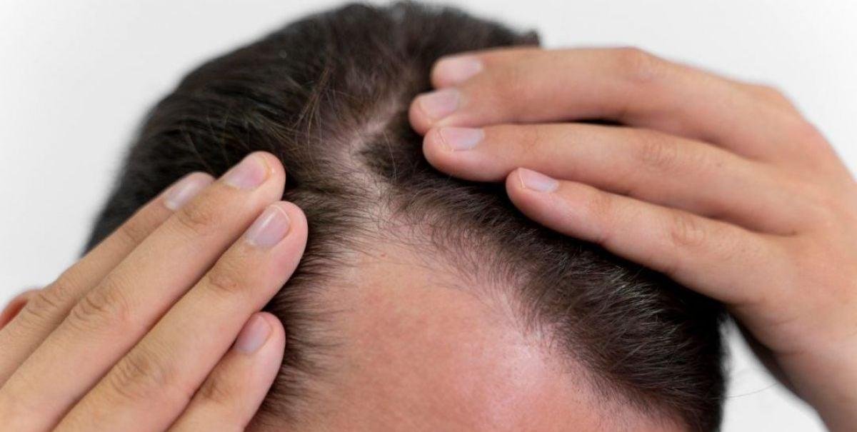Implante capilar: cómo funciona y cuáles son las técnicas del procedimiento